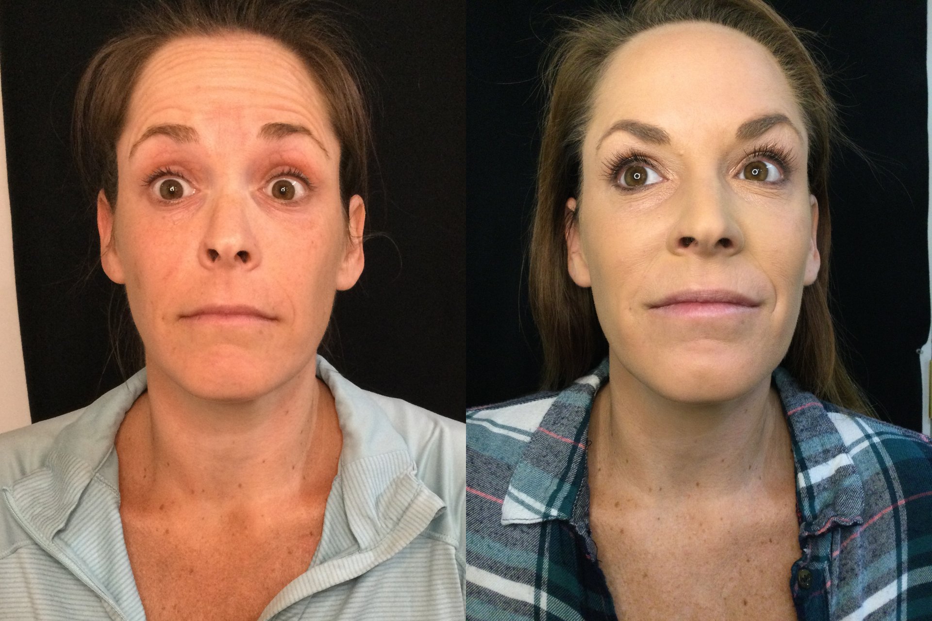 botox-treatments-near-me-hilton-head-plastic-surgery-medspa