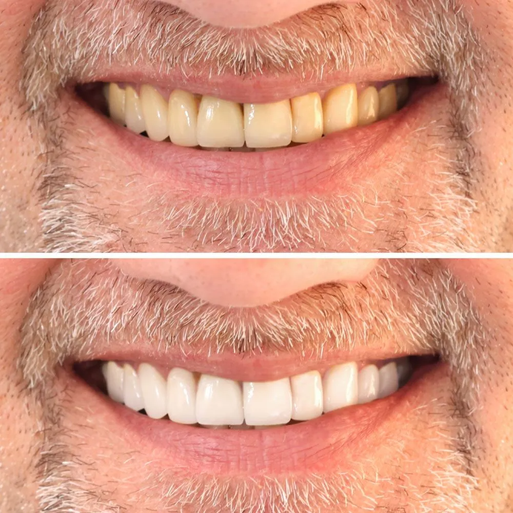 Before-and-after comparison of a person's teeth, showing a change from stained and yellowed to bright white.