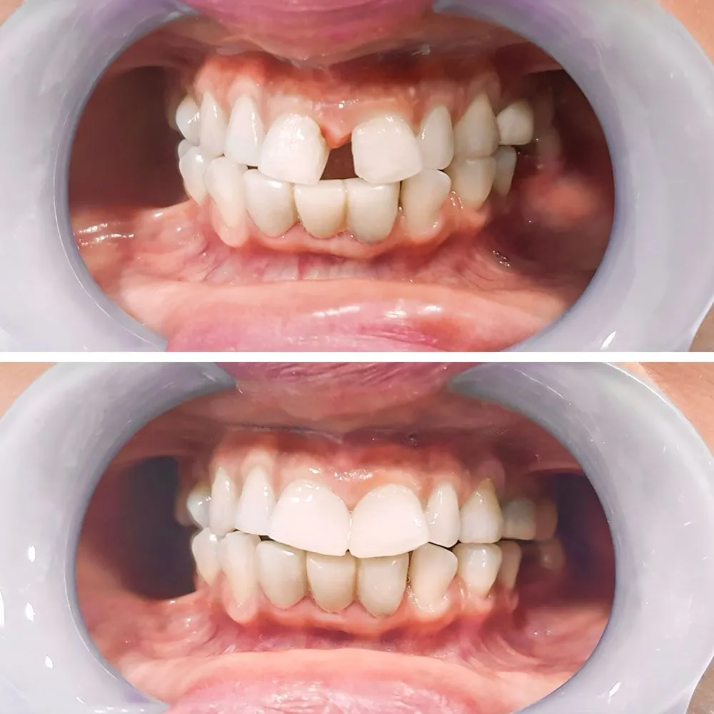 Before and after view of a dental procedure closing the gap between two front teeth.