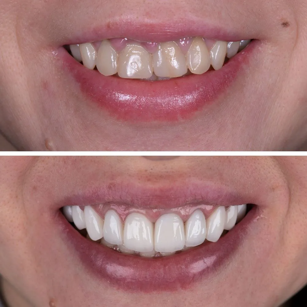 Before-and-after comparison showing a smile transformation with brighter, more uniform teeth after dental veneers.