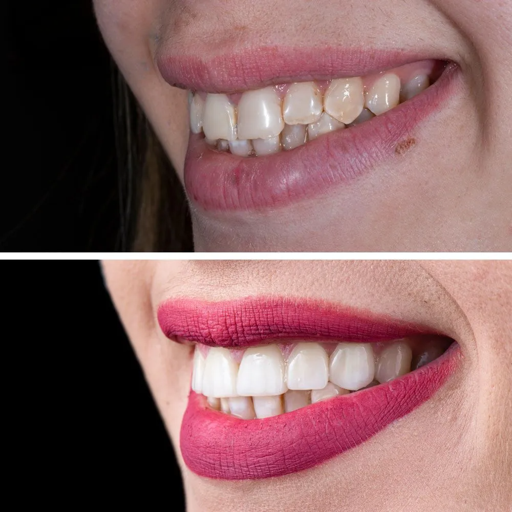 Before-and-after comparison of a person's smile, showing teeth whitening and cosmetic dental improvements.