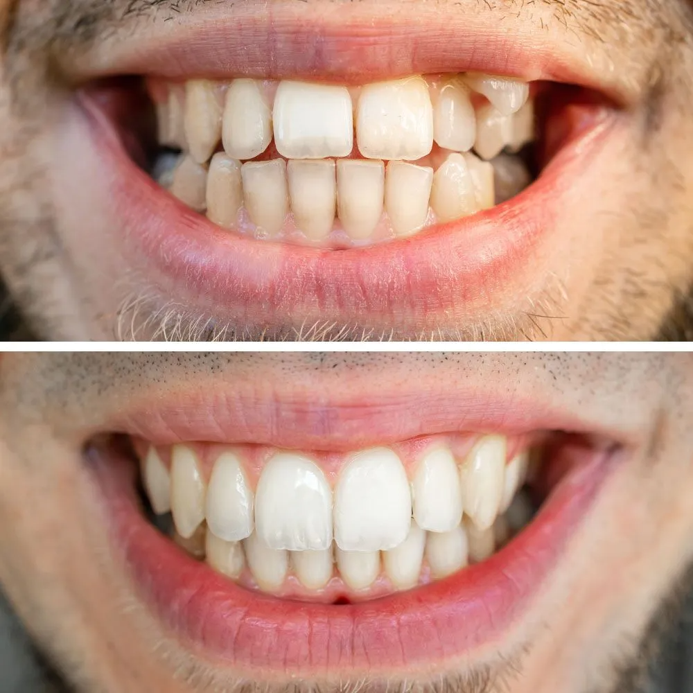 Before and after close-up of a person's teeth showing improvement in brightness and alignment after a dental procedure.