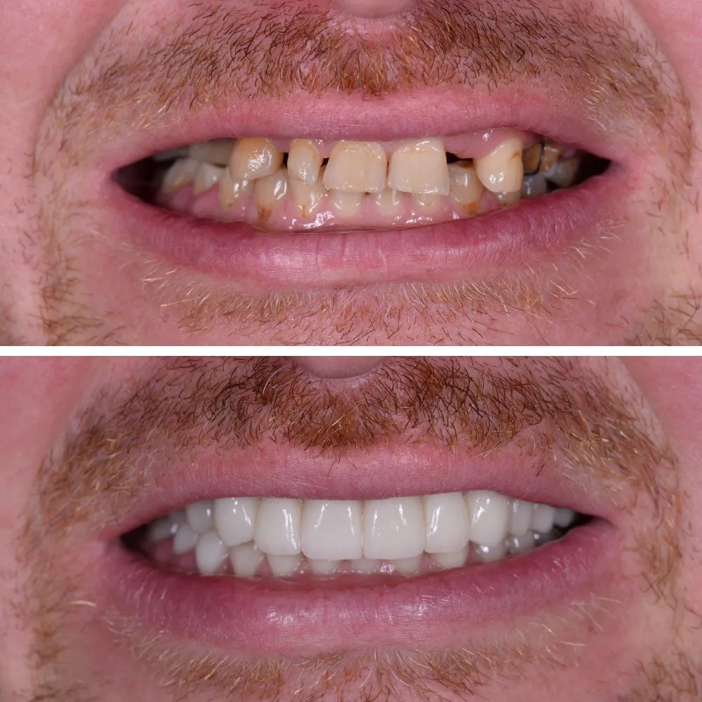 A side-by-side comparison of teeth before and after a dental restoration, showing improved alignment and brightness.