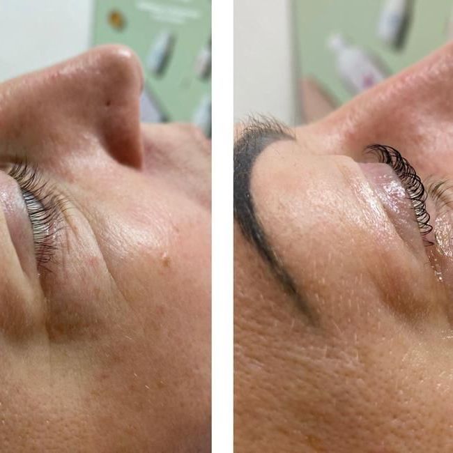 Viene mostrato il volto di una donna prima e dopo un trattamento viso.