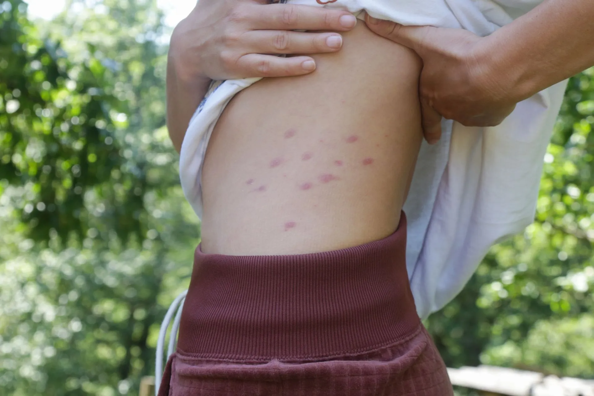 A Person Reveal a Cluster of Reddish, Raised Bumps on Their Side — Pest Storm In Summerland Point, NSW