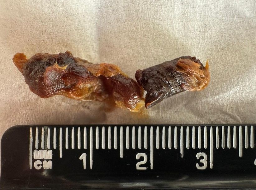 a close up of some ear wax removed using warm water irrigation