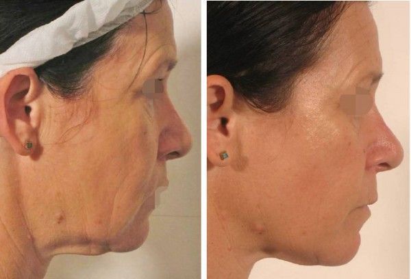 icl-skincare-therapy-before-and-after