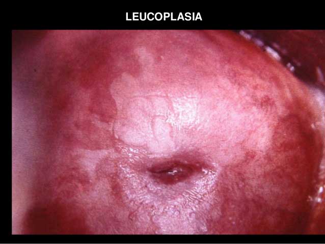 DRA. DAFNE NISHAN OLLIVIER - leucoplasia