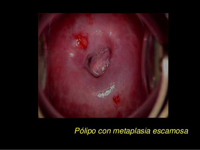 DRA. DAFNE NISHAN OLLIVIER - pólipos