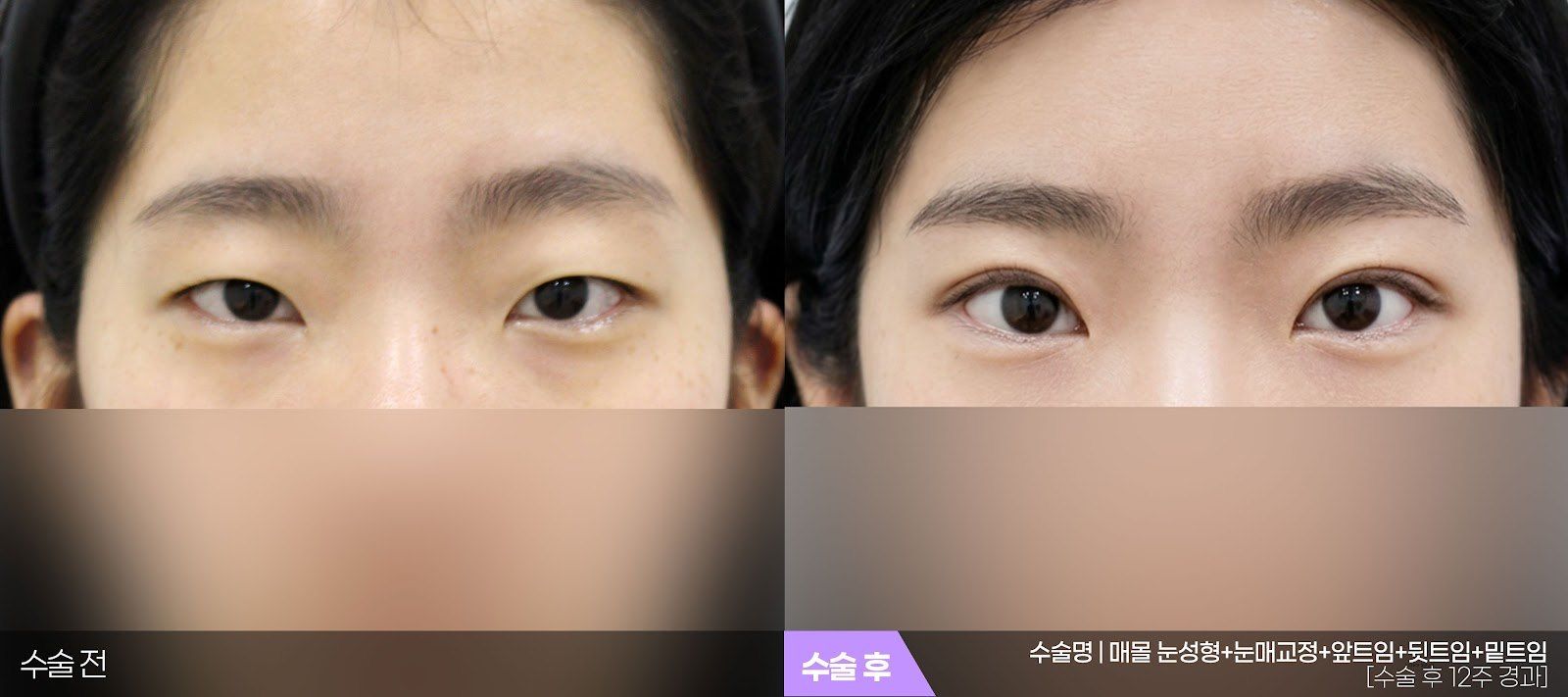 부산 티엔티성형외과 쌍꺼풀 + 눈매교정 + 트임 수술 전후 사진 — 수술 후 12주