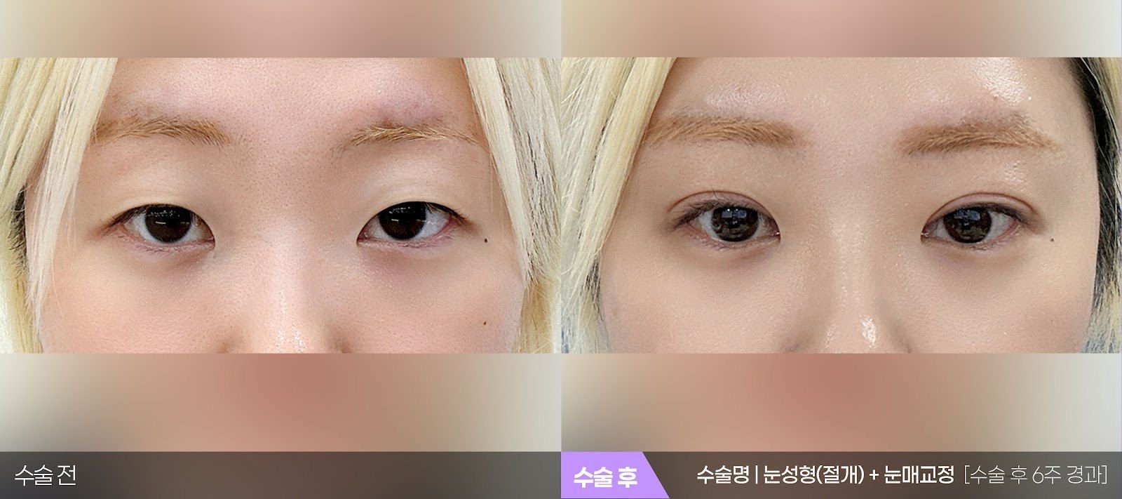 부산 티엔티성형외과 절개법 쌍꺼풀 + 눈매교정 전후 사진 — 수술 후 6주
