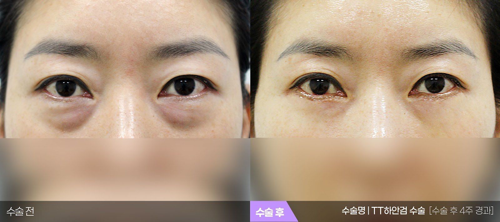 부산 티엔티성형외과 하안검 수술(눈밑 지방) 전후 사진 — 하안검 케이스