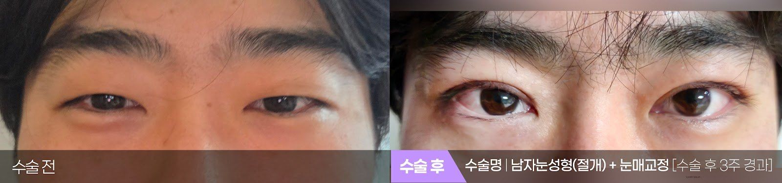 부산 티엔티성형외과 남자 눈성형: 절개법 쌍꺼풀 + 눈매교정 전후 사진 — 수술 후 3주