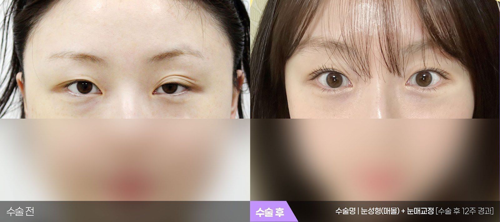 부산 티엔티성형외과 매몰법 쌍꺼풀 + 눈매교정 전후 사진 — 쌍꺼풀 케이스