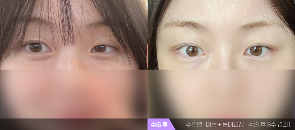 부산 티엔티성형외과 매몰법 쌍꺼풀 + 눈매교정 전후 사진 — 수술 후 3주