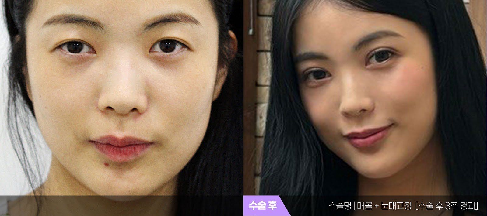 부산 티엔티성형외과 매몰법 쌍꺼풀 + 눈매교정 전후 사진 — 수술 후 3주