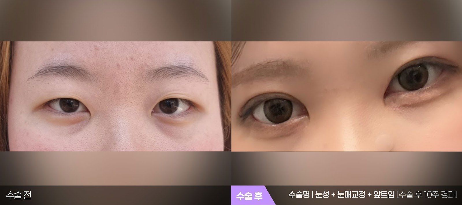 부산 티엔티성형외과 매몰법 쌍꺼풀 + 눈매교정 + 앞트임 전후 사진 — 수술 후 10주