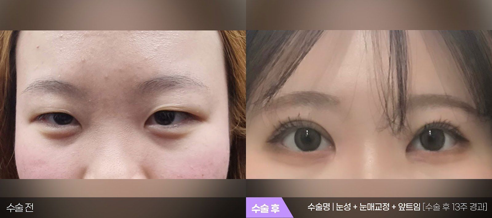 부산 티엔티성형외과 매몰법 쌍꺼풀 + 눈매교정 + 앞트임 전후 사진 — 수술 후 13주