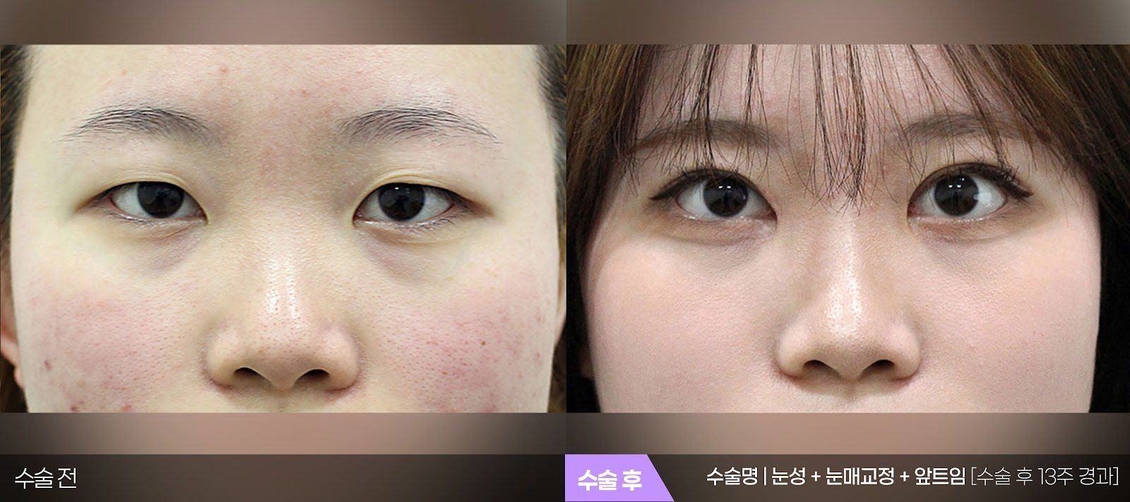부산 티엔티성형외과 매몰법 쌍꺼풀 + 눈매교정 + 앞트임 전후 사진 — 수술 후 13주