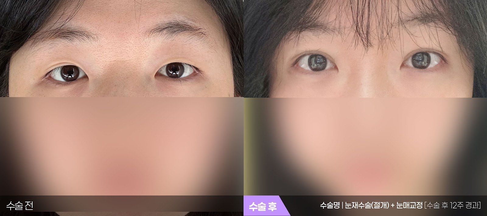 부산 티엔티성형외과 눈 재수술 + 눈매교정 전후 사진 — 재수술 케이스