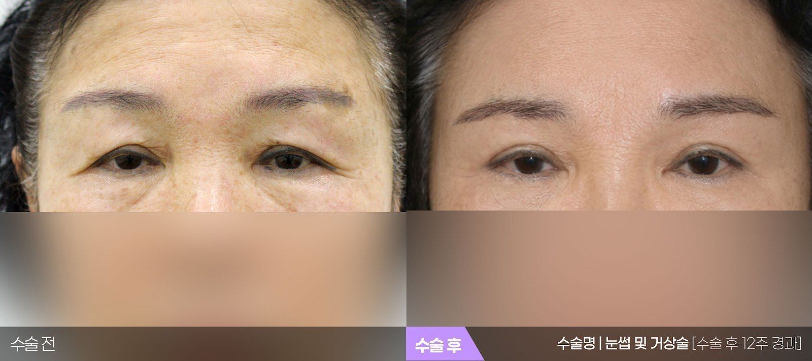부산 티엔티성형외과 눈썹밑 거상술(무거운 윗눈꺼풀) 전후 사진 — 수술 후 12주
