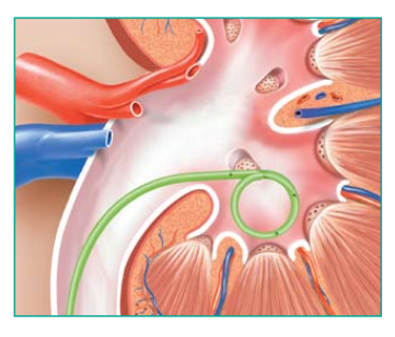 A drawing of a kidney with a needle in it