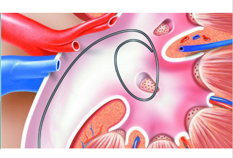 A drawing of a kidney with a needle in it