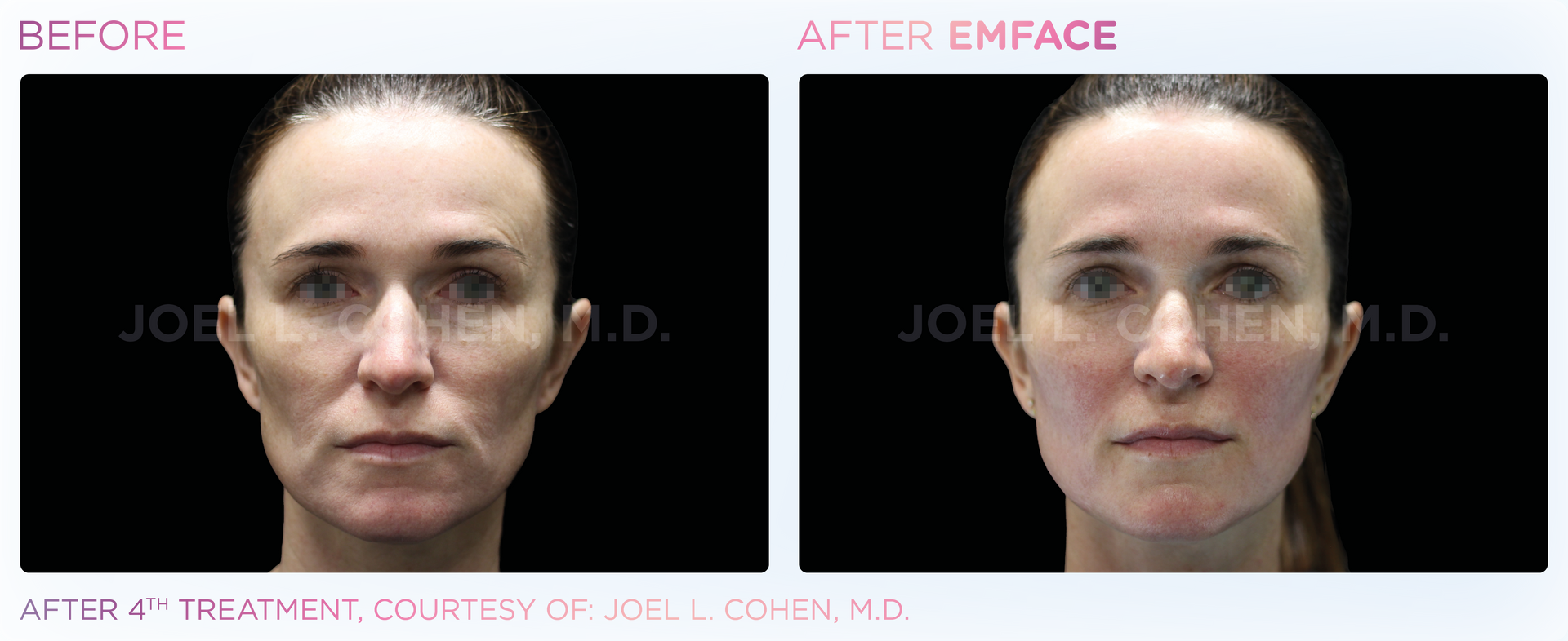 Emface