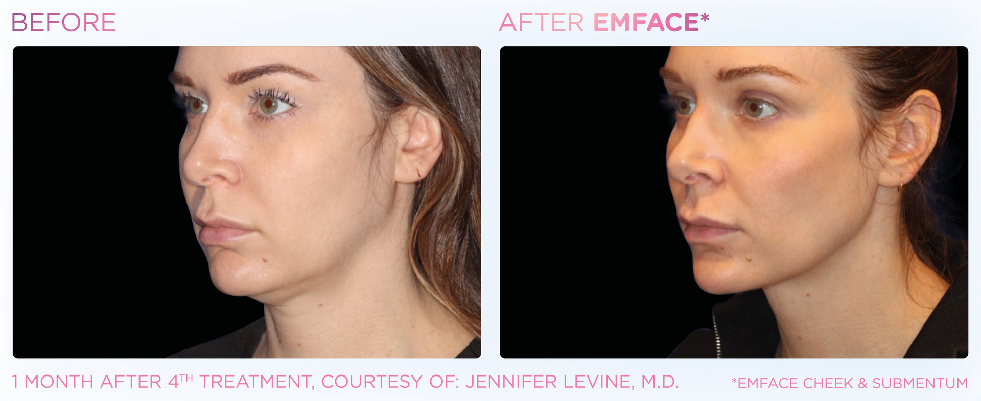 Emface submentum before and after