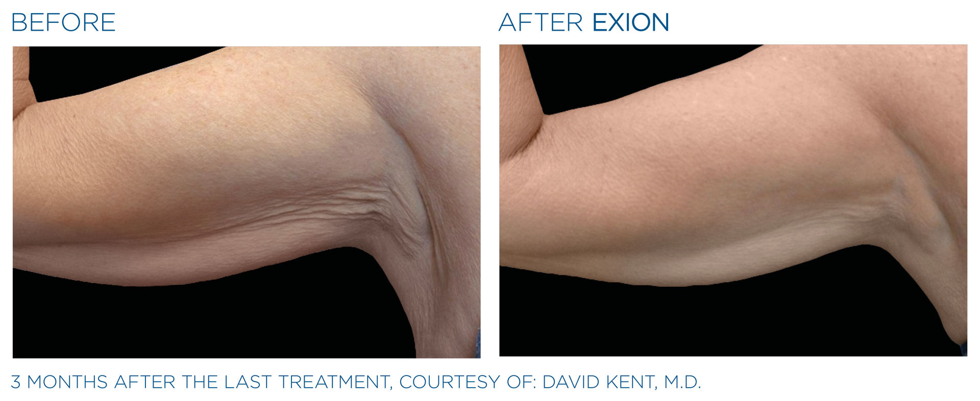Exion