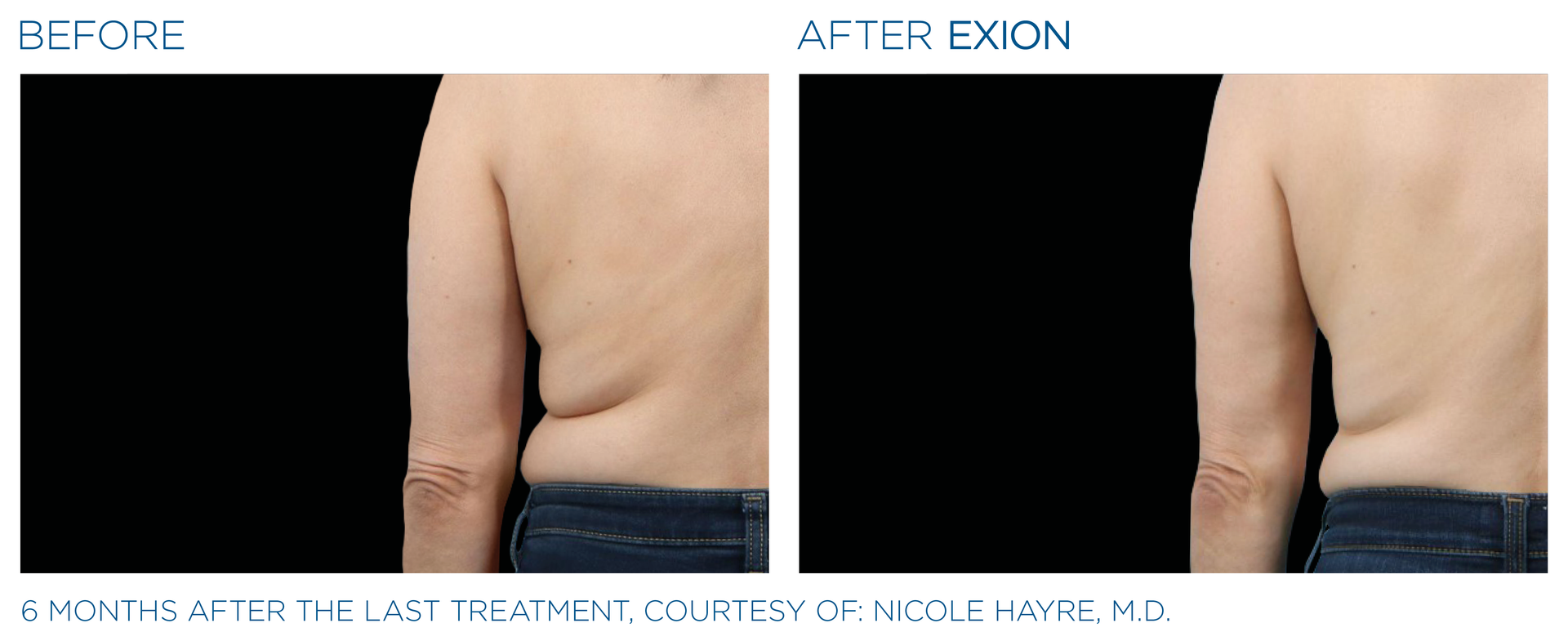 Exion