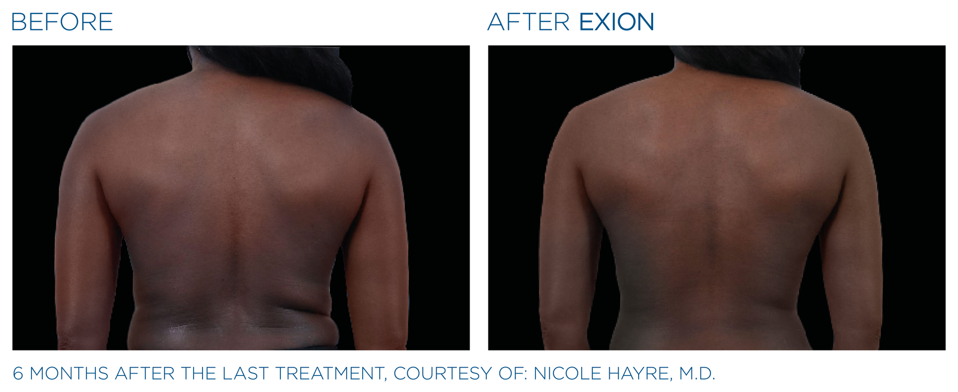 Exion