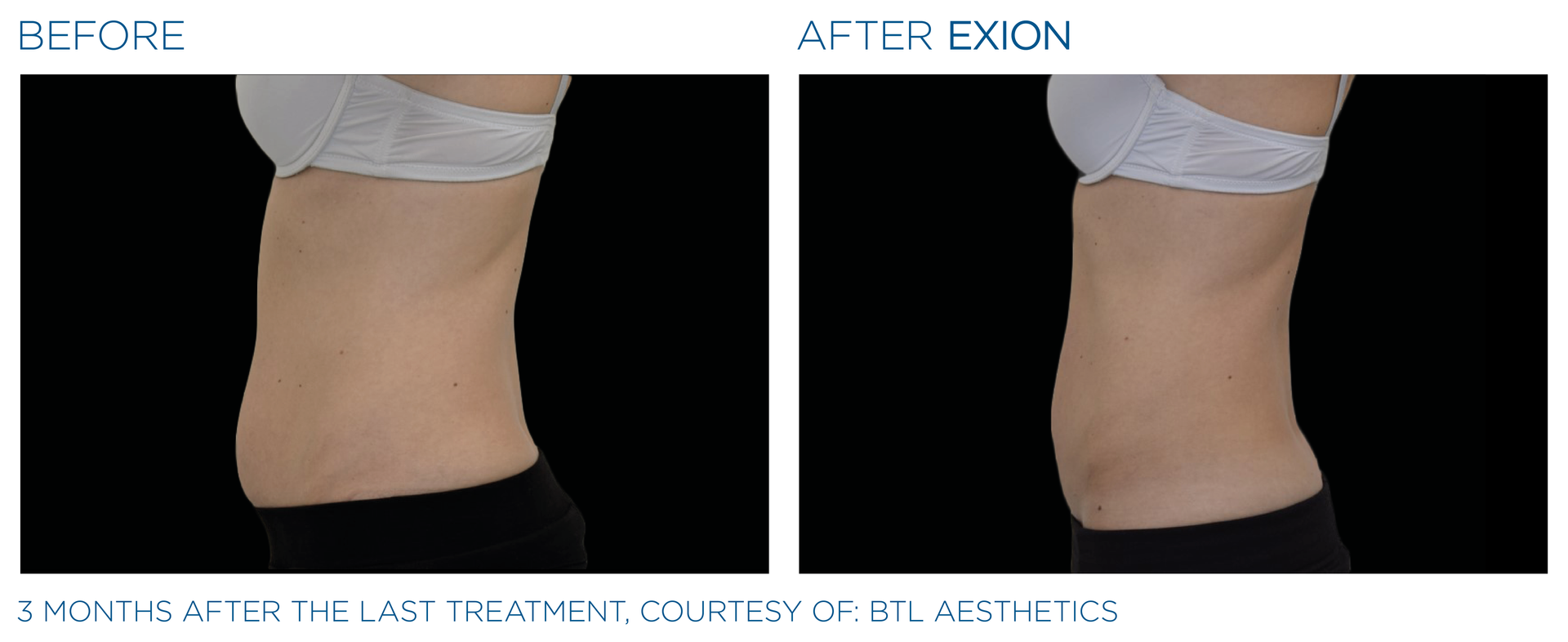 EXION before and after abdomen