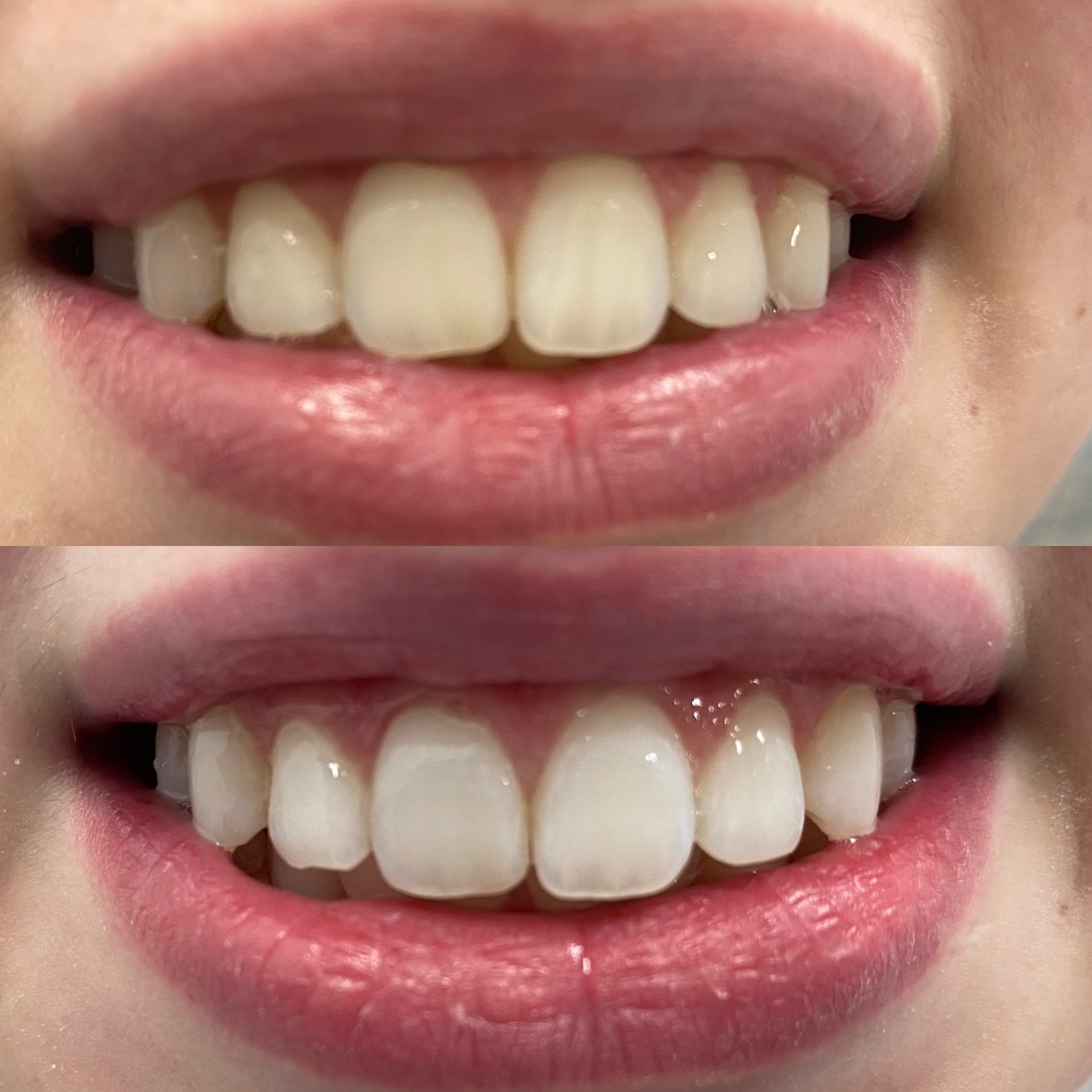 Teeth Whitening in Louisville Advanced Dental Center