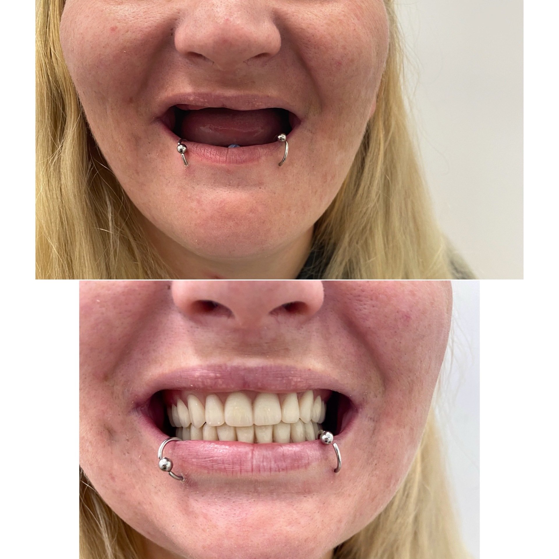 Dentures in Louisville Advanced Dental Center