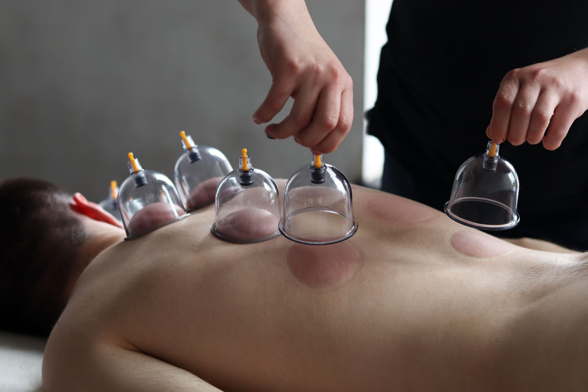 Person receiving cupping therapy on back with glass cups attached by hands Person receiving cupping therapy on back with glass cups attached by hands