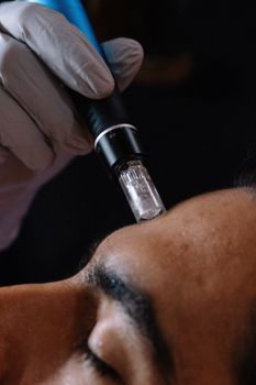 Microneedling handpiece being used on a man's cheek during a skin treatment