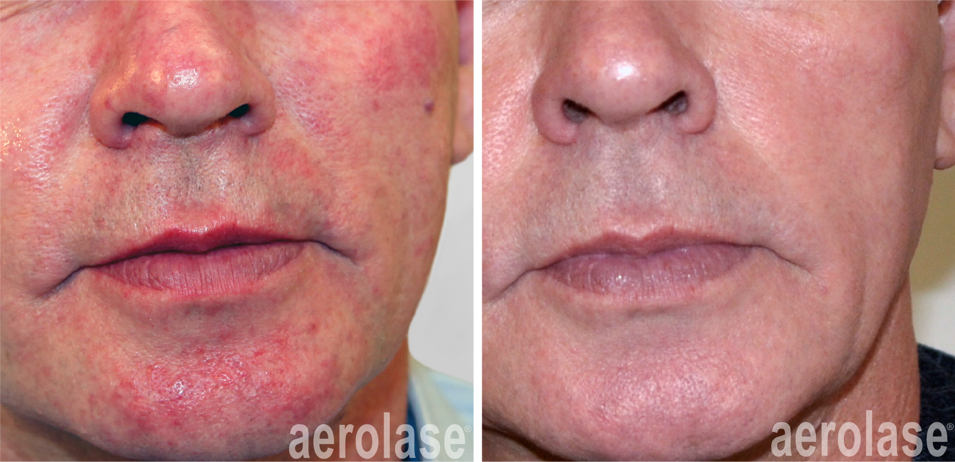 Rosacea, Redness, and Veins — Greenwood, IN — Vigor Health and Beauty Rosacea, Redness, and Veins — Greenwood, IN — Vigor Health and Beauty