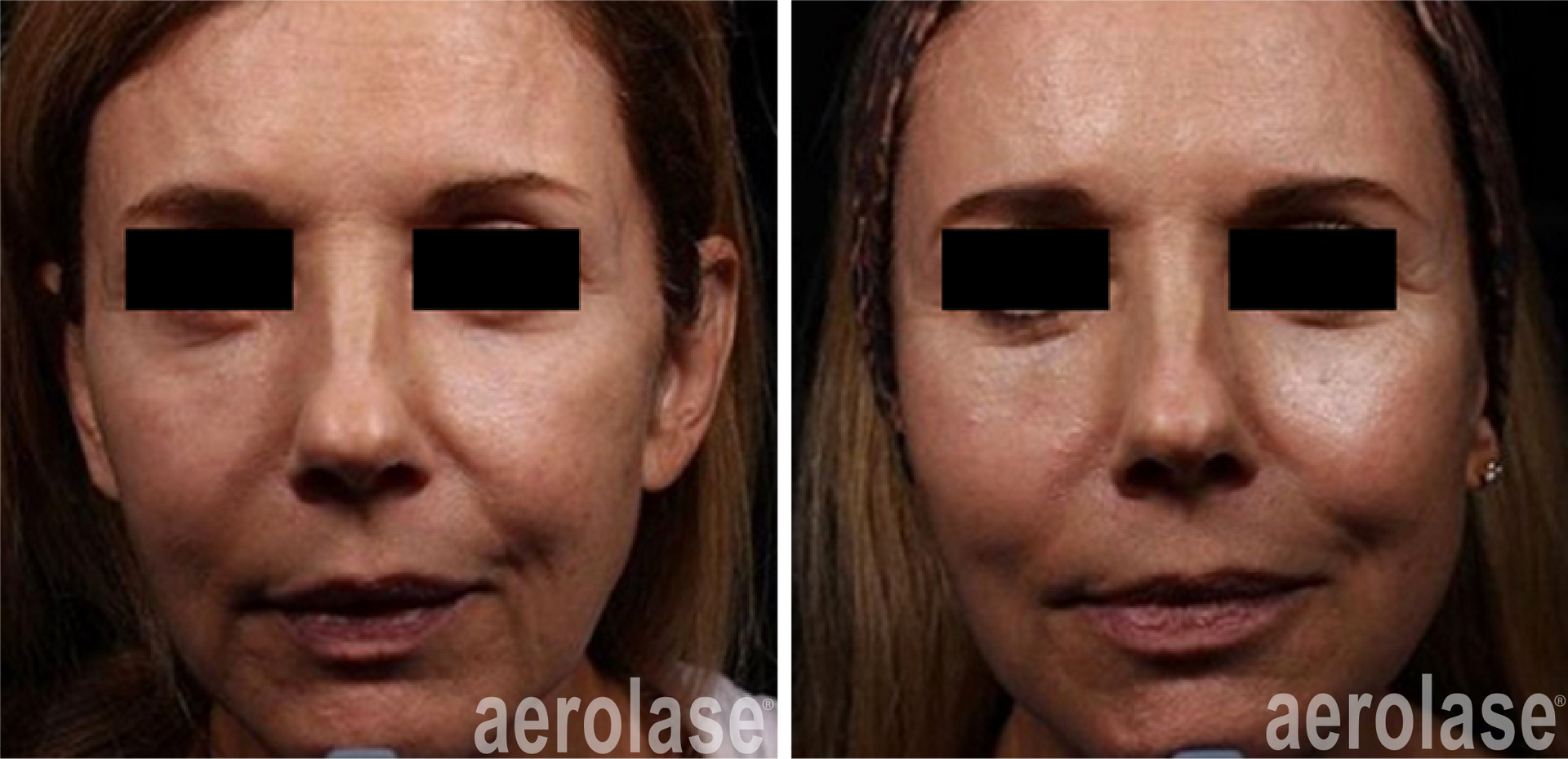 Rejuvenation and Tightening — Greenwood, IN — Vigor Health and Beauty Rejuvenation and Tightening — Greenwood, IN — Vigor Health and Beauty