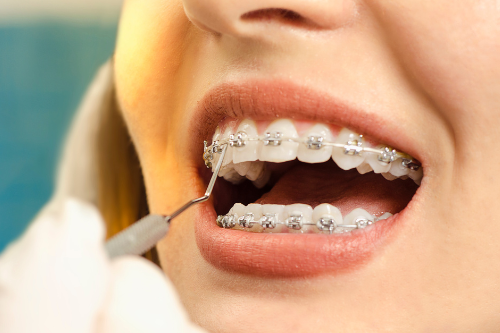 a young man with curly hair has braces on his teeth