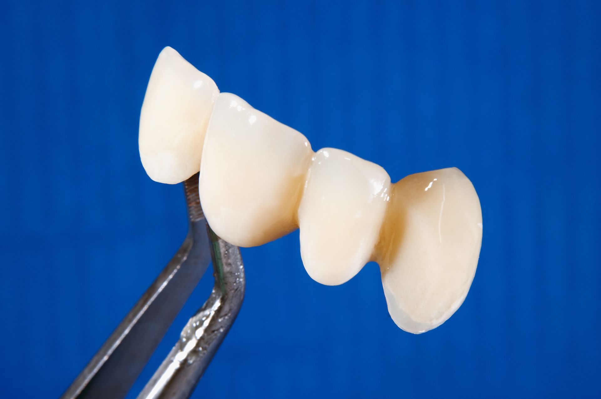 Dental Crowns — Marysville, WA — Jeffrey L. Erwin DDS