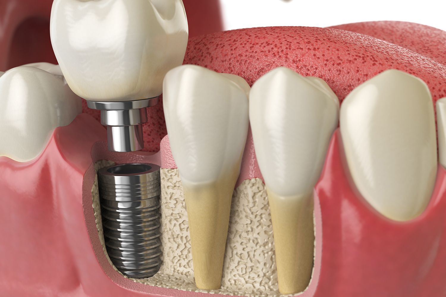 A 3D illustration showing a dental implant with a crown placed in the jawbone next to natural teeth A 3D illustration showing a dental implant with a crown placed in the jawbone next to natural teeth