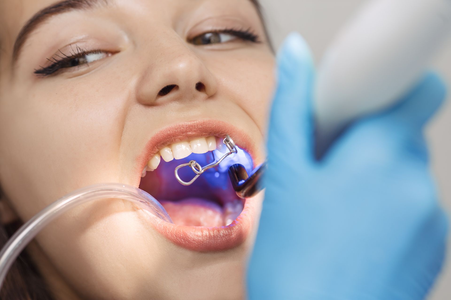 Dental Bonding — Marysville, WA — Jeffrey L. Erwin DDS