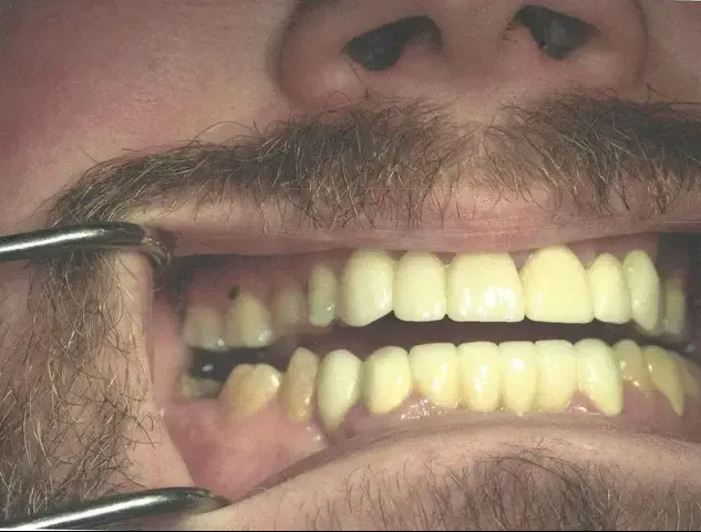 Close-up view of a person’s mouth held open by metal retractors to show a full set of teeth and dental restorations.