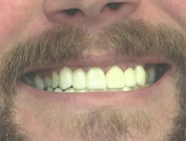 A close-up of a person's mouth with a mustache, showing a bright smile with white, aligned teeth.