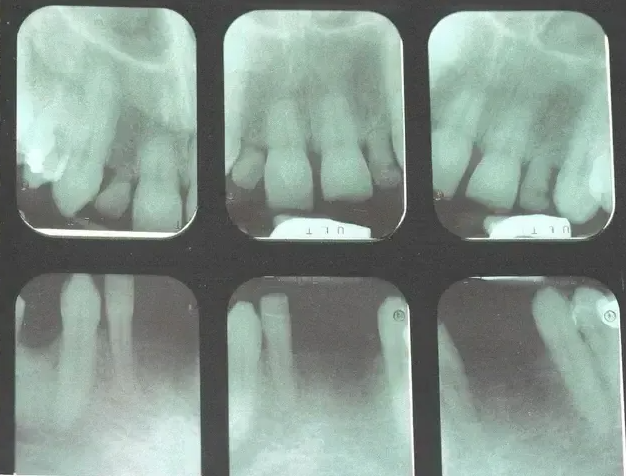 A dental radiographic series showing six periapical X-rays of the upper and lower teeth.