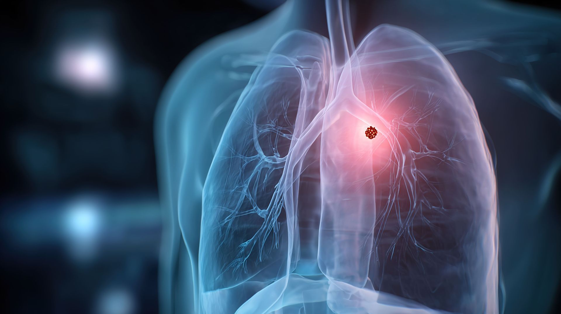 nódulo pulmonar em jovens