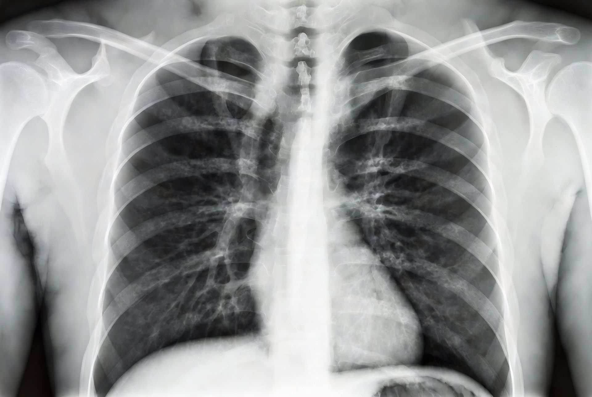 derrame pleural recorrente