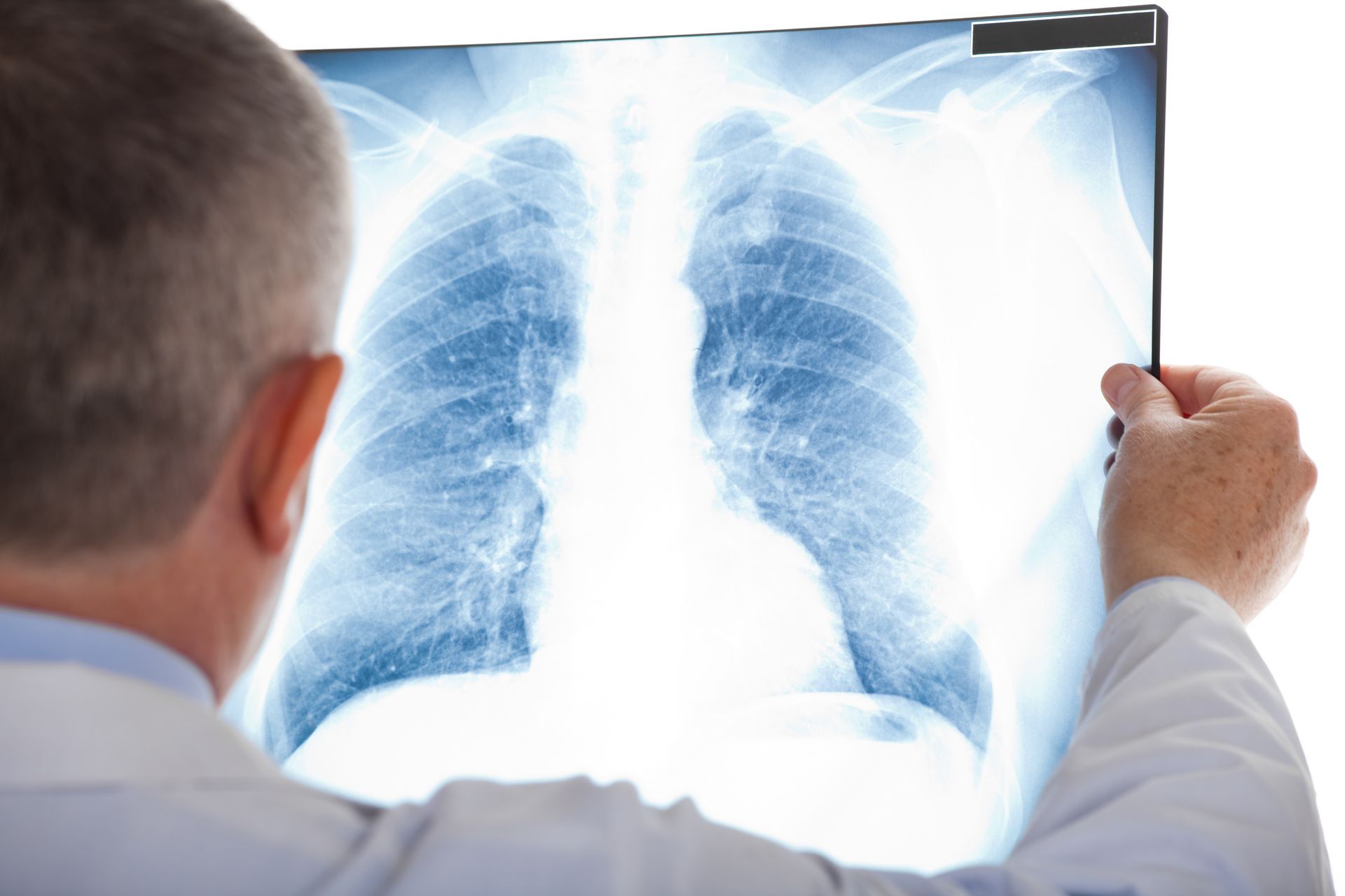 Médico analisando radiografia de tórax, associada à avaliação de nódulos pulmonares