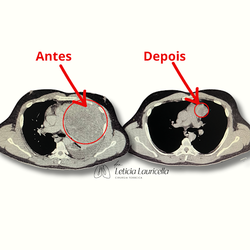 Imagem ilustrativa para tumor germinativo do mediastino